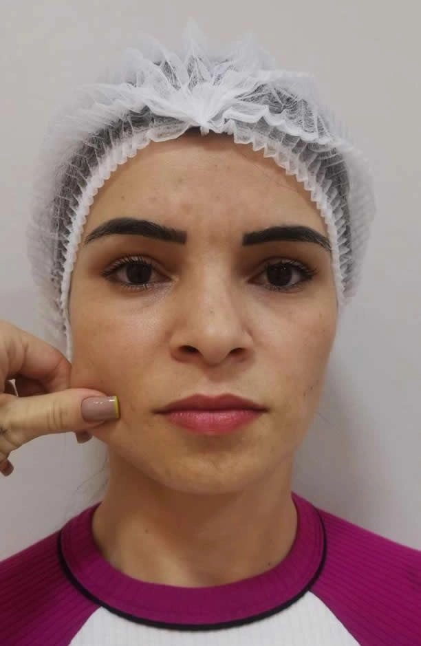 Bioestimulador de Colágeno Clínica de Estética BH