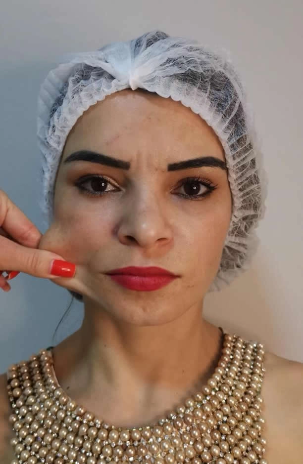 Bioestimulador de Colágeno Clínica de Estética BH