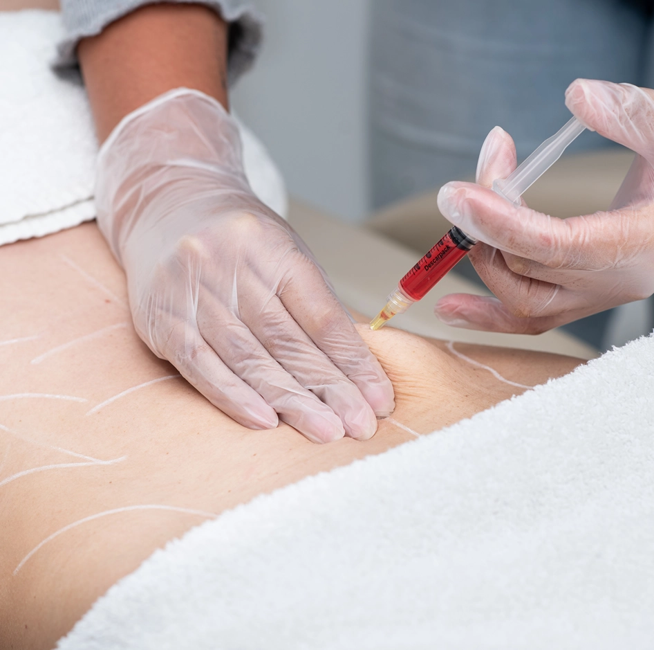 Lipo Enzimática Clínica de Estética BH