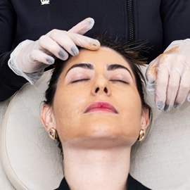 Peeling Químico Clínica de Estética BH